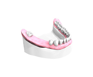 Remplacer plusieurs dents absentes ou abîmées - Dentiste