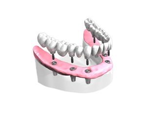 Remplacer toutes les dents absentes ou abîmées - Dentiste